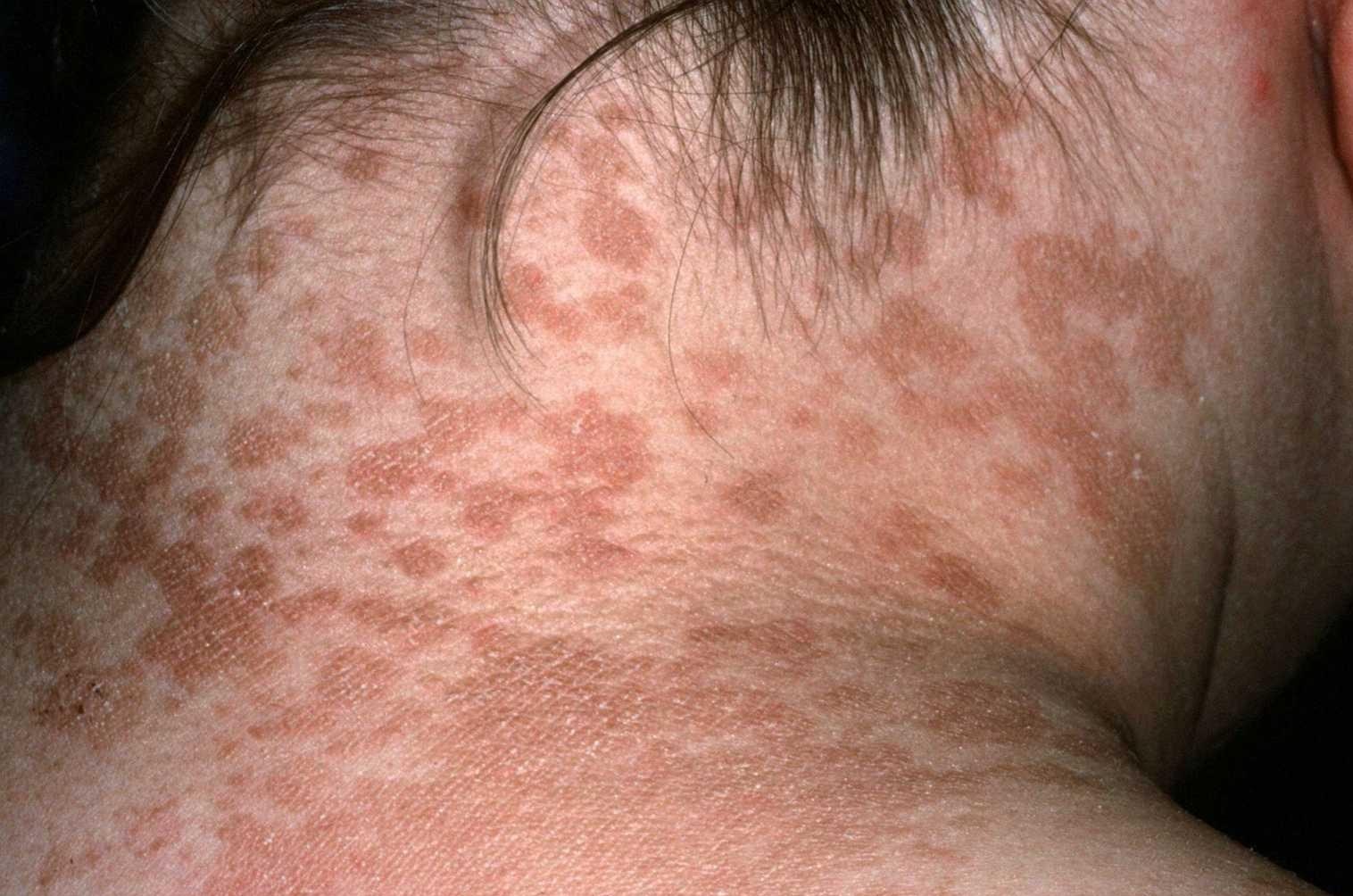 الفرق بين البهاق والفطريات