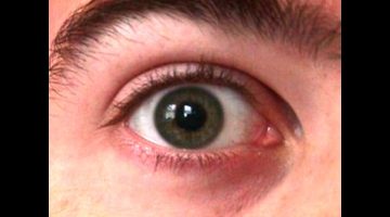 هل الغدة الدرقية سببها العين والحسد